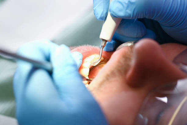 Best Dentist for Tooth Abscess  in Cleves, OH