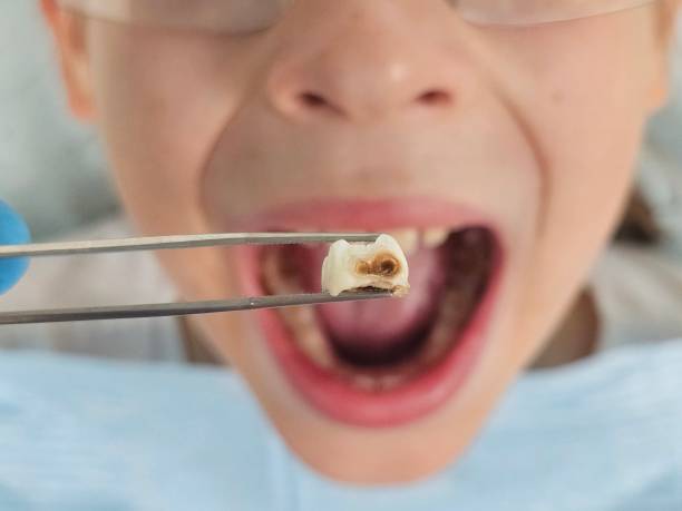 Best Urgent Tooth Repair  in Cleves, OH